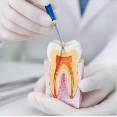 Root Canal